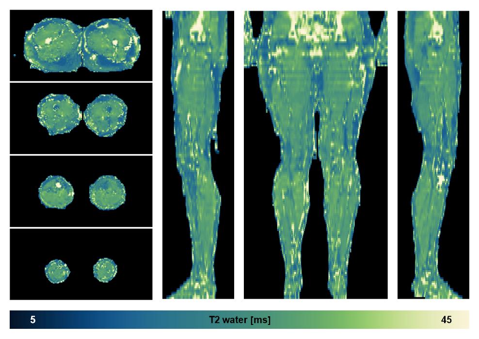 The water only T2 relaxation time of the lower extremity obtained from multi echo spin echo t2 mapping with EPG based reconstruction.